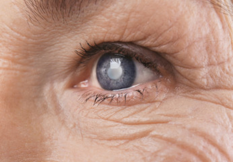 Cirurgia Catarata a Laser Preço Penha de França - Cirurgia no Olho Catarata