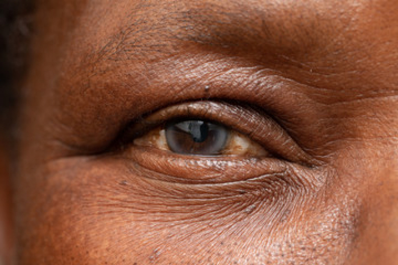 Cirurgia Catarata a Laser Região Central - Cirurgia no Olho Catarata