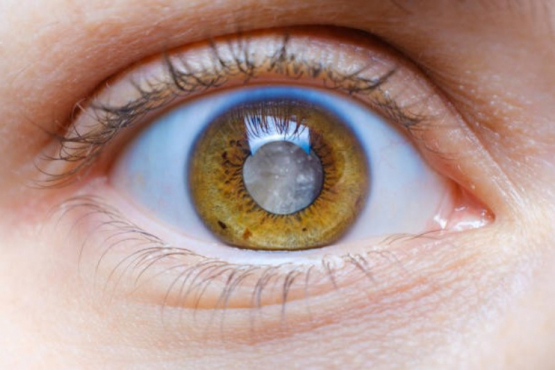 Cirurgia de Catarata a Laser Preço Avenida Rebouças - Cirurgia de Catarata no Olho