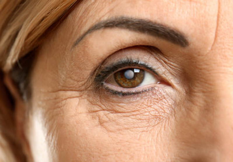 Cirurgia de Catarata Faco Refrativa Preço Aricanduva - Cirurgia de Catarata no Olho