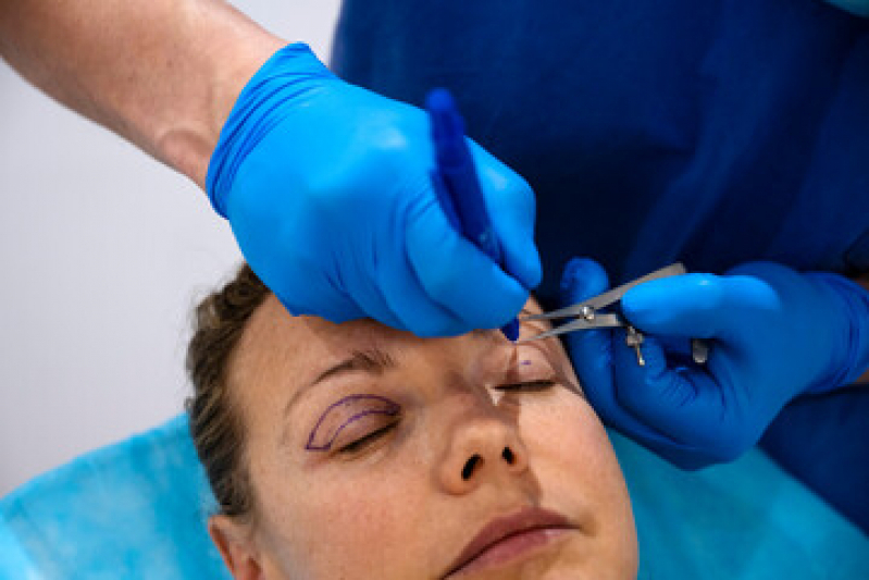 Cirurgia de Desobstrução de Via Lacrimal Valores Itaim Paulista - Cirurgia Plástica Ocular Blefaroplastia