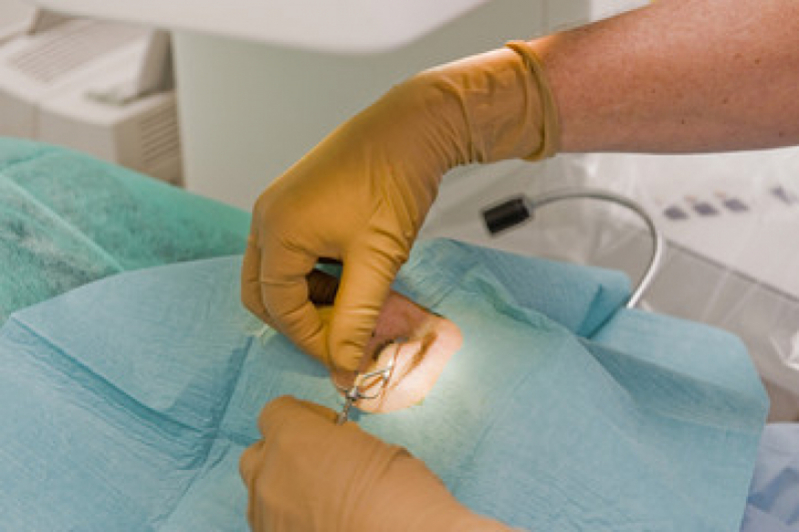 Cirurgia Faco Refrativa para Maiores de 50 Anos Higienópolis - Cirurgia a Laser nos Olhos
