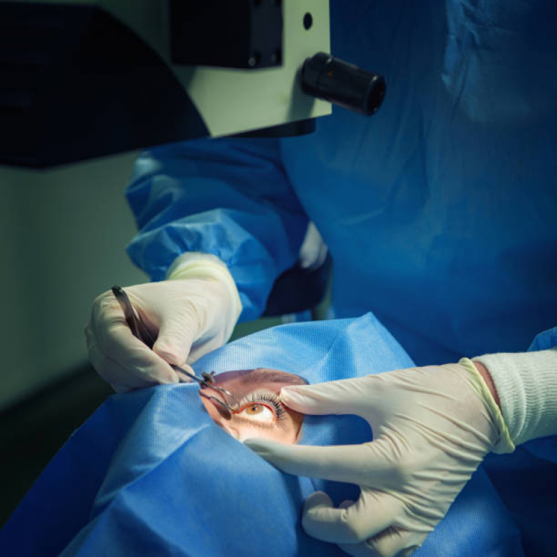Cirurgia para Ceratocone Valor Cambuci - Anéis Intra Estromais para Ceratocone