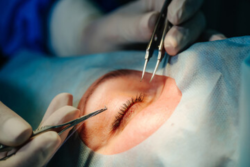 Cirurgia para Miopia Valores Butantã - Cirurgia Faco Refrativa para Maiores de 50 Anos