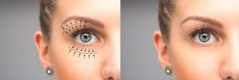 Cirurgia Plástica nos Olhos Preços Chácara Santo Antônio - Cirurgia Plástica Ocular a Laser