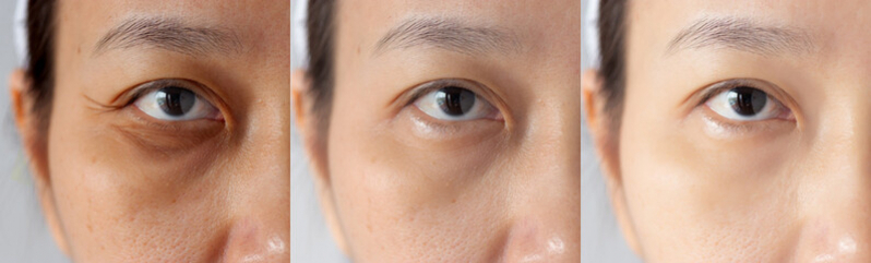 Cirurgia Plástica Ocular para Deformações da Palpebra Valores Ana Rosa - Cirurgia Plástica Ocular para Deformações da Palpebra