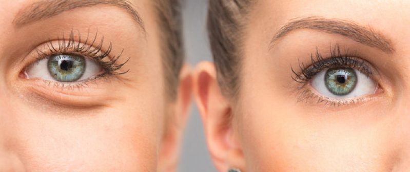 Cirurgia Plástica Ocular para Deformações da Palpebra Praça da Arvore - Cirurgia Plástica Ocular a Laser