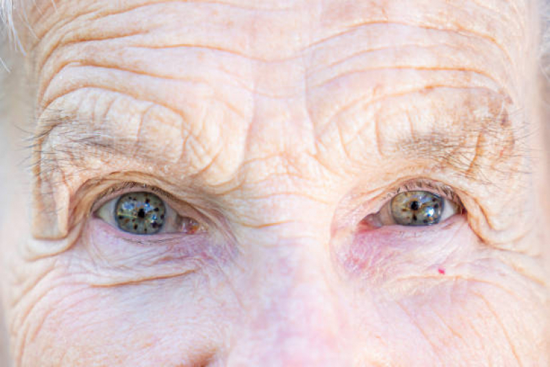 Degeneração da Retina Tratamento Valores Bom Retiro - Degeneração Macular Relacionada à Idade