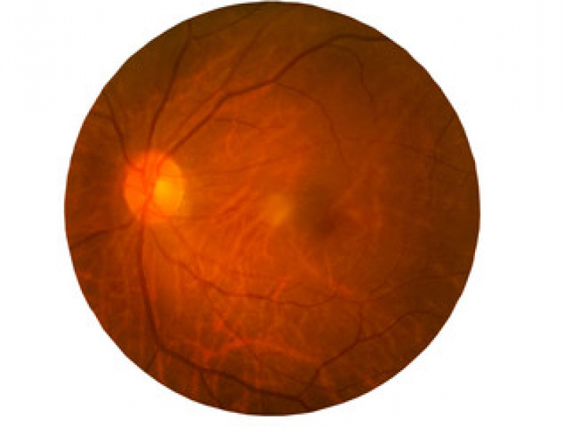 Degeneração Macular Cirurgia à Laser Jabaquara - Degeneração Macular da Retina