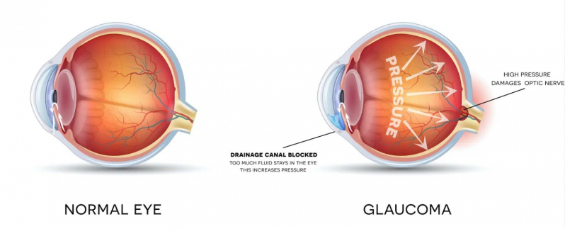 Diagnóstico para Glaucoma Butantã - Glaucoma de Corticoide