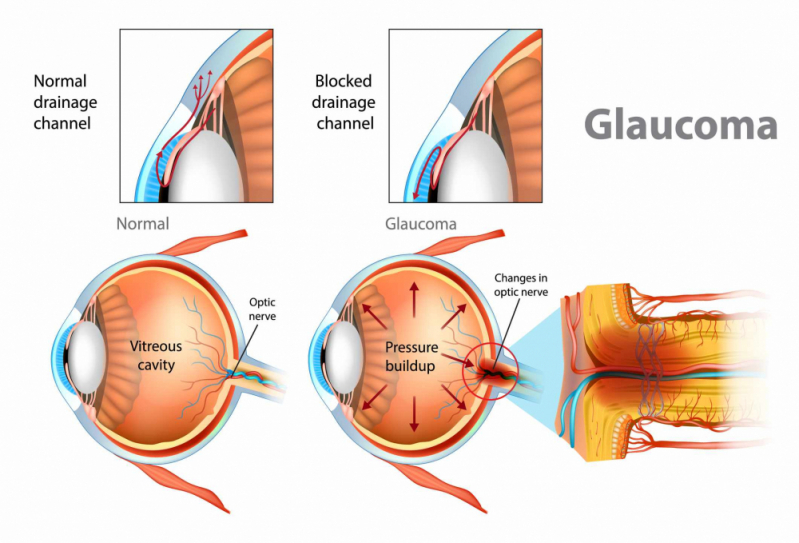 Exame de Cirurgia de Glaucoma Jardim Paulistano - Glaucoma de ângulo Aberto