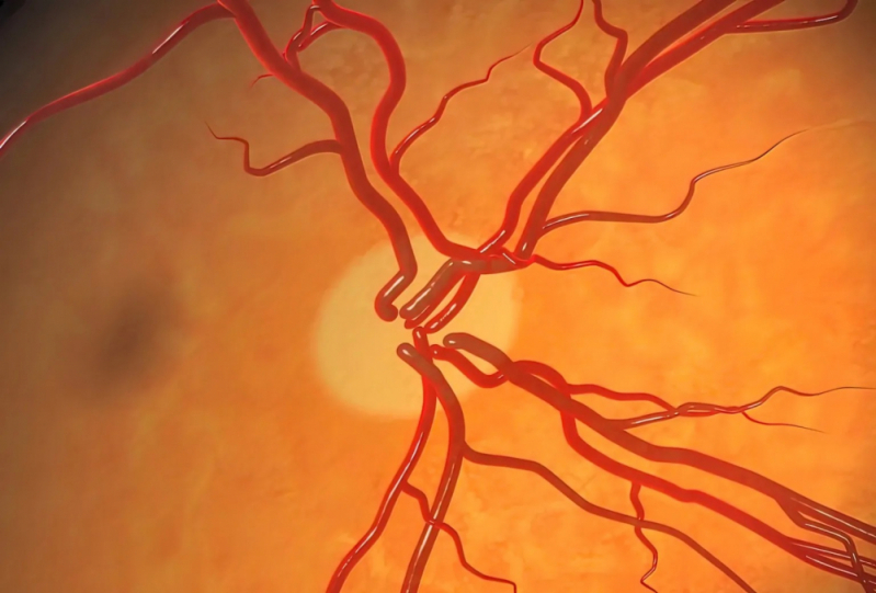 Exame de Tratamento a Laser para Glaucoma Jardins - Glaucoma de ângulo Aberto