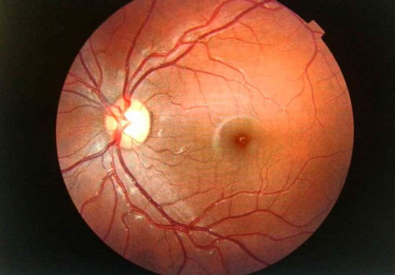 Glaucoma ângulo Fechado Clínica Real Parque - Glaucoma de Corticoide