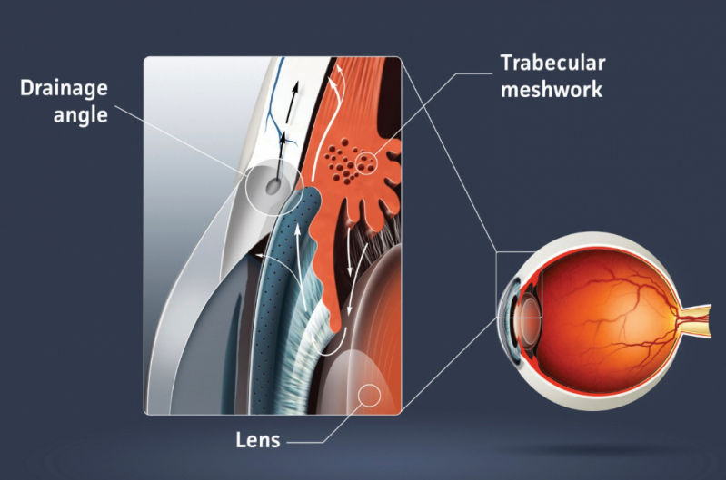 Glaucoma ângulo Fechado Sapopemba - Cirurgia de Glaucoma