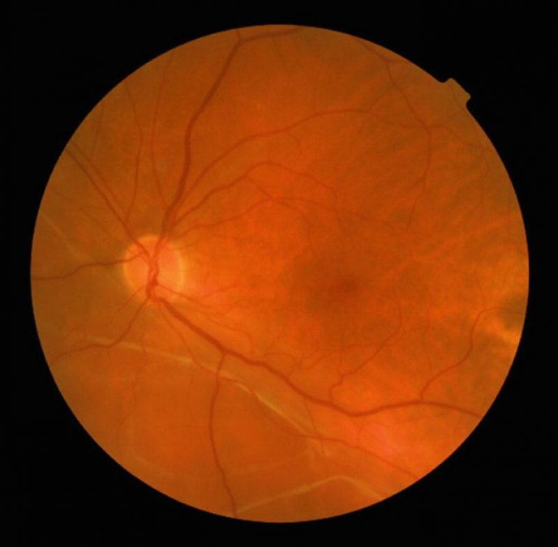 Glaucoma Corticoide Clínica Sacomã - Glaucoma de ângulo Aberto
