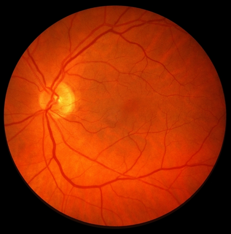 Glaucoma Corticoide Pompéia - Glaucoma de ângulo Aberto