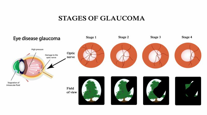 Glaucoma de ângulo Aberto Clínica Chácara Flora - Glaucoma de Corticoide