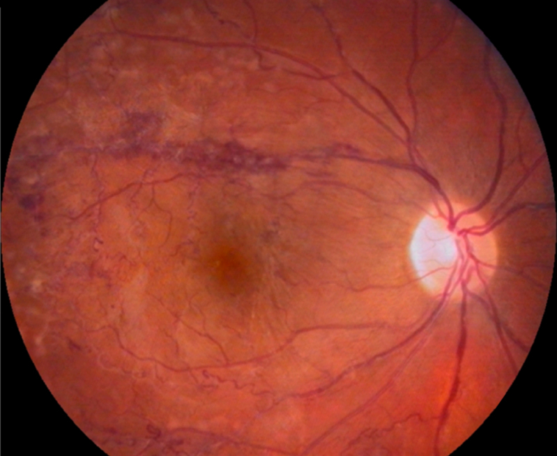 Glaucoma Infantil Clínica Brás - Tratamento a Laser para Glaucoma