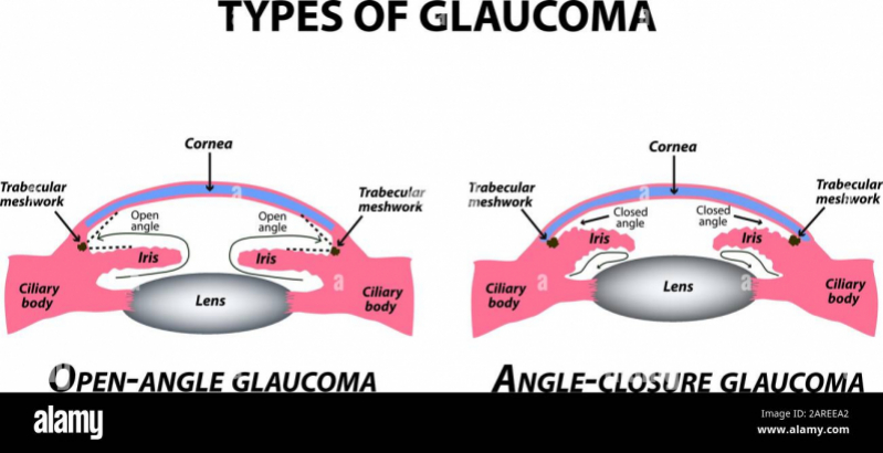 Glaucoma Infantil Tucuruvi - Glaucoma Infantil