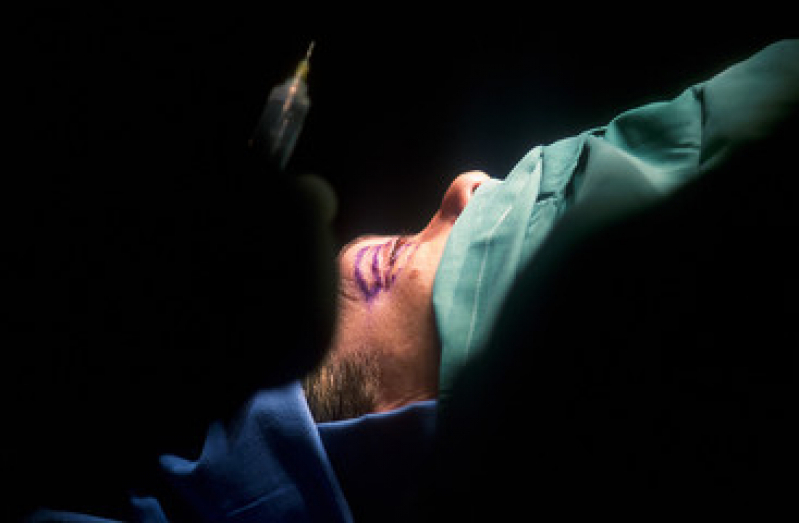 Onde Faz Cirurgia de Desobstrução de Via Lacrimal Paraíso - Cirurgia Plástica para Os Olhos