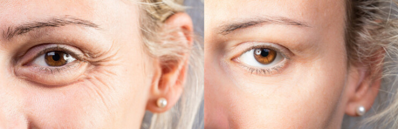 Onde Faz Cirurgia Plástica Ocular para Deformações da Palpebra Augusta - Cirurgia Plástica Oftalmológica