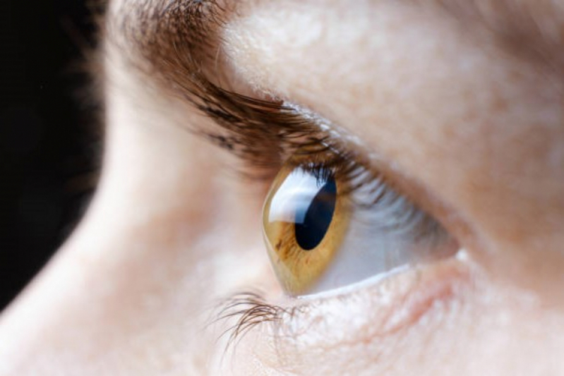 Onde Faz Tratamento de Córnea Inflamada Interlagos - Tratamento de Córnea dos Olhos