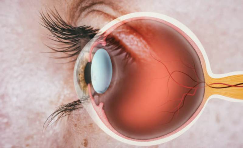 Onde Fazer Mapeamento de Retina Glaucoma Chacara Klabin - Mapeamento da Retina para Mácula