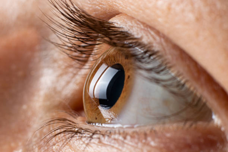 Onde Fazer Transplante Ocular Tatuapé - Transplante de Córnea Especial