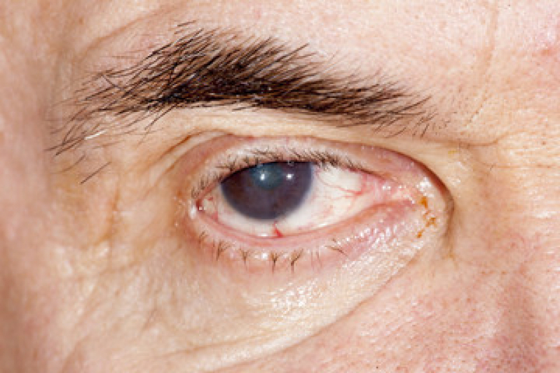Preço de Cirurgia de Catarata com Implante de Lente Especial Butantã - Cirurgia de Catarata no Olho