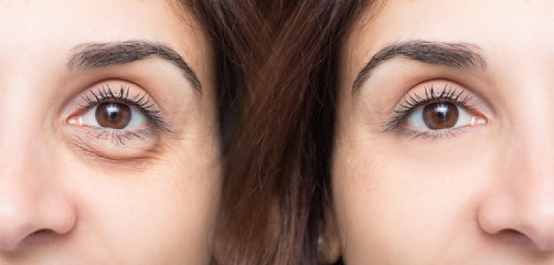 Preço de Cirurgia Plástica Ocular para Deformações da Palpebra Liberdade - Cirurgia Plástica nos Olhos
