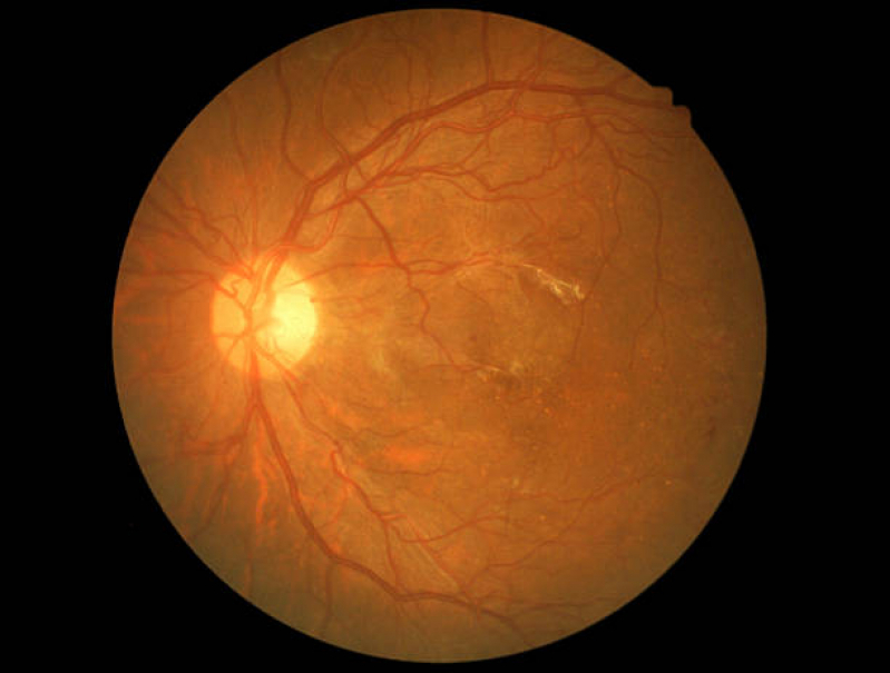 Retinopatia Diabética Fotocoagulação a Laser Tratamento Jardim Paulista - Retinopatia Diabética Fundo de Olho