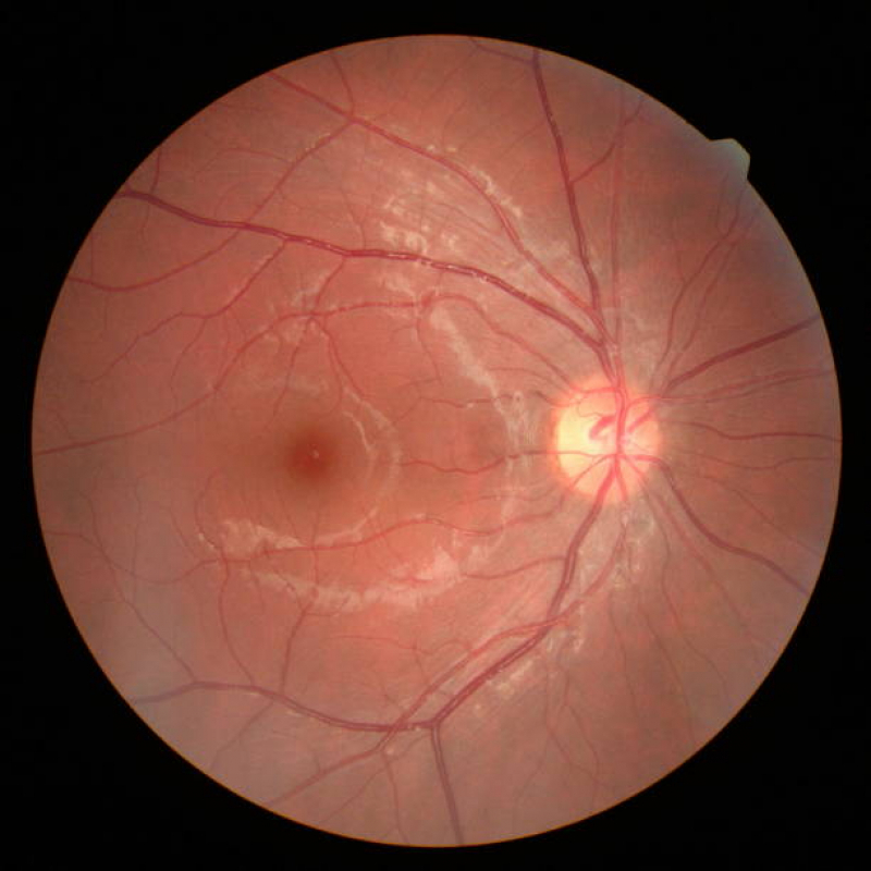 Retinopatia Diabética Fotocoagulação a Laser Alto da Boa Vista - Retinopatia Diabética Fundo de Olho