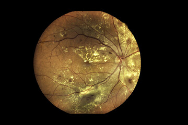retinopatia-diabtica-grave