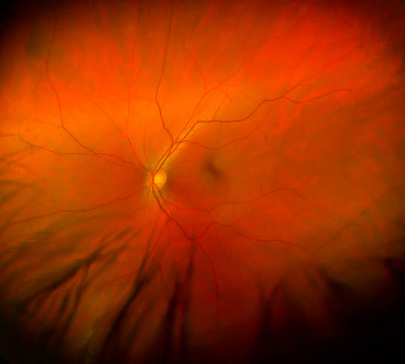 Retinopatia Diabética Tratamento a Laser Tratamento Sapopemba - Retinopatia Diabética Fundo de Olho