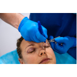 cirurgia plástica ocular a laser valores Ana Rosa