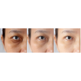 Cirurgia Plástica Ocular para Deformações da Palpebra