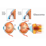 exame de cirurgia de glaucoma Parque do Carmo