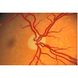 exame de tratamento a laser para glaucoma Paineiras do Morumbi