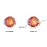 exame de tratamento para glaucoma secundário Vila Andrade