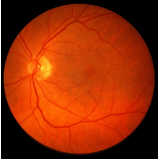 glaucoma corticoide República