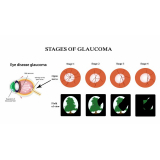 glaucoma de ângulo aberto clínica Heliópolis