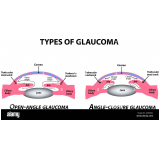 glaucoma infantil Tucuruvi