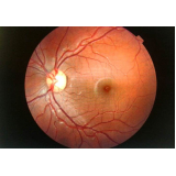 Tratamento para Glaucoma Secundário