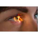mapeamento de retina glaucoma agendar Pompéia