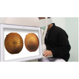 retinopatia diabética avançada Pacaembu