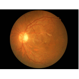 retinopatia diabética cirurgia tratamento Vila Prudente