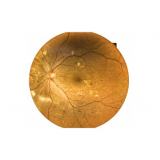 retinopatia diabética com edema macular preços Cambuci
