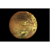 retinopatia diabética com edema macular tratamento Vila Gumercindo