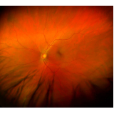 retinopatia diabética fisiopatologia tratamento Congonhas