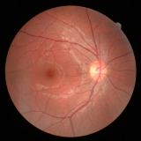 retinopatia diabética fotocoagulação a laser Campos Elísios